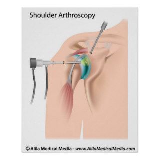 Shoulder arthroscopy diagram. print